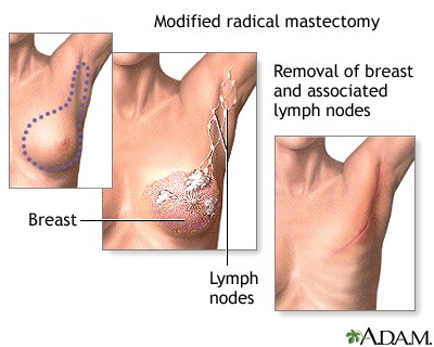 Modified radical mastectomy